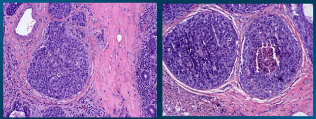 High power view histopathology (H & E)