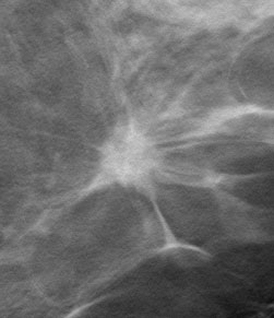 digital tomosynthesis