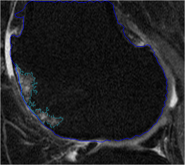 Bone marrow lesion volume