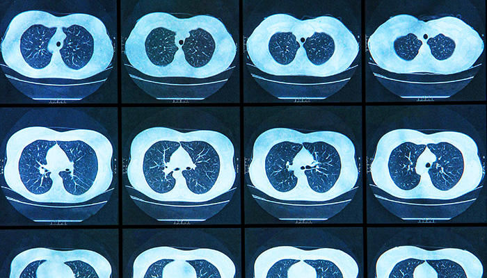 Severe Asthma Program