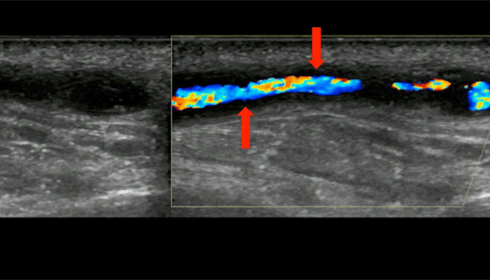 Noninvasive Vascular Ultrasound