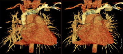 Case of a 35 year old male with Scimitar syndrome.